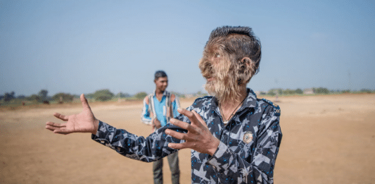 Lalit Patidar, syndrom vlkodlaka